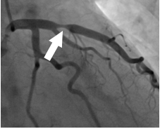 Coronary Angioplasty Stenting